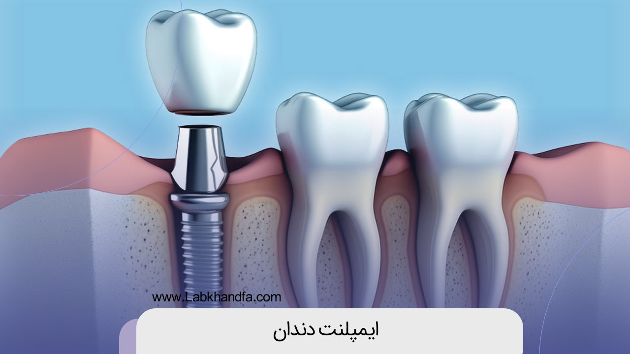 ایمپلنت دندان