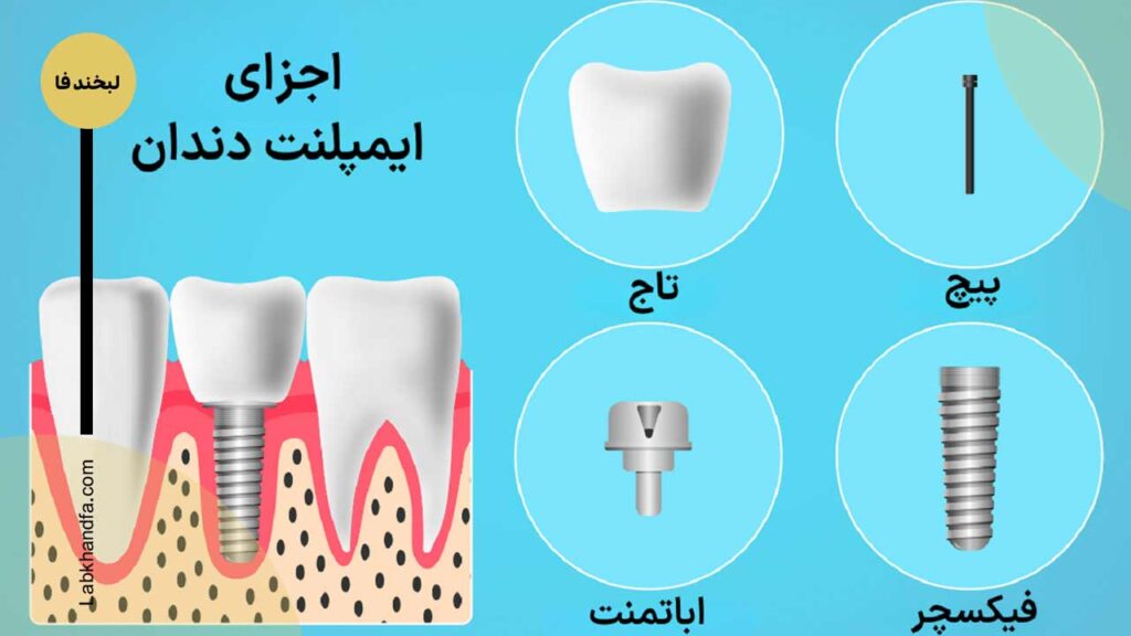 اینفوگرافی اجزای تشکیل دهنده ایمپلنت دندان