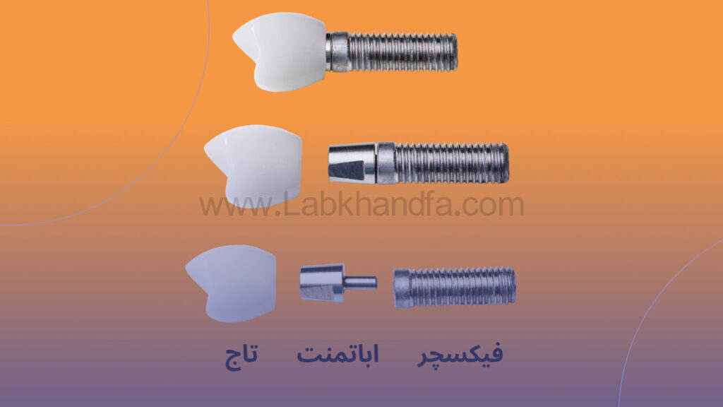 اینفوگرافی اجزای تشکیل دهنده ایمپلنت دندان