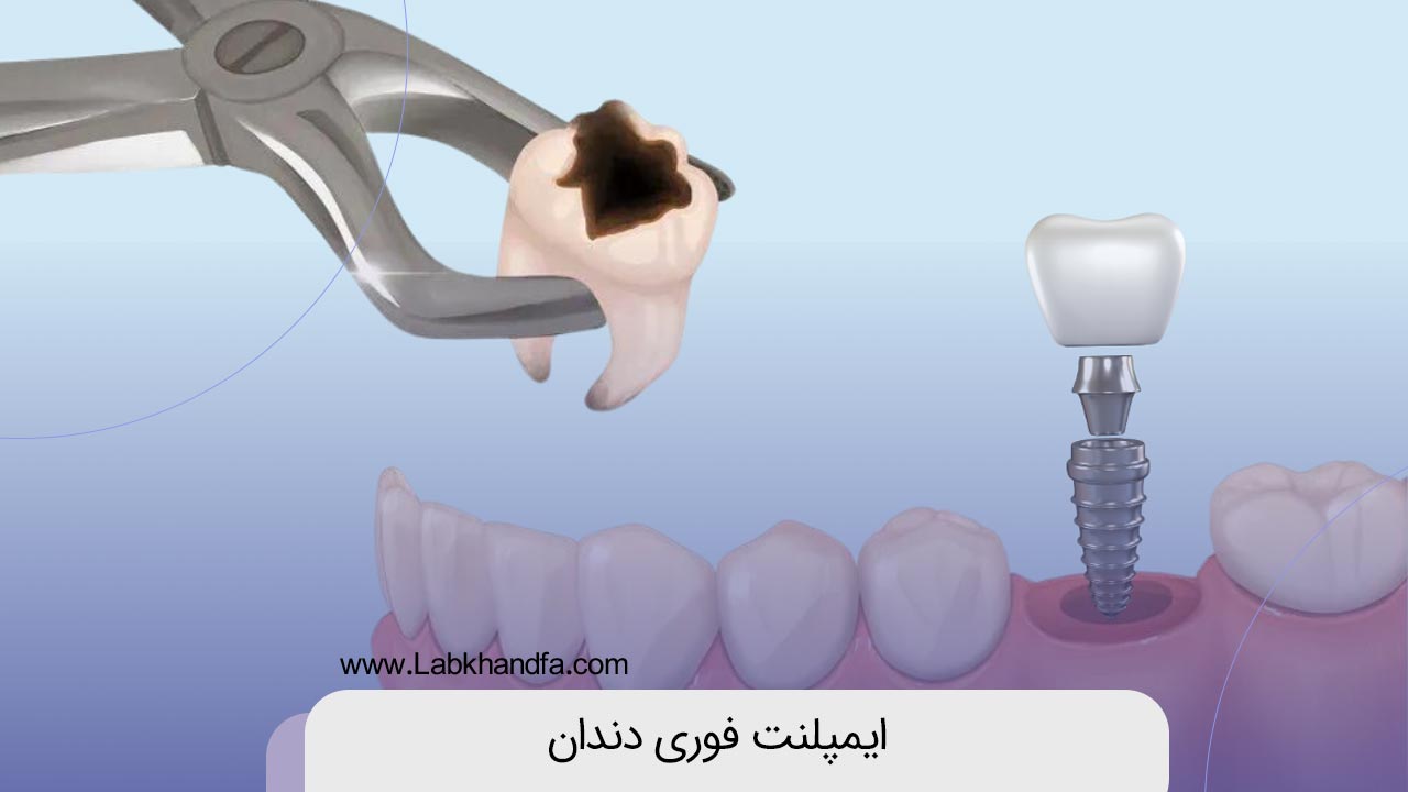 ایمپلنت فوری