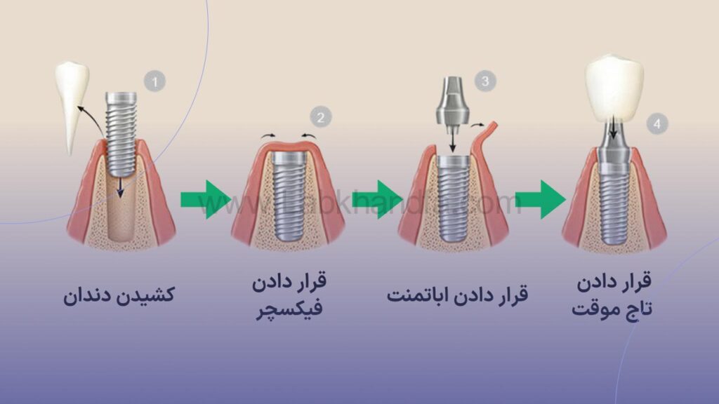 تصویر اینفوگرافیک مراحل ایمپلنت فوری