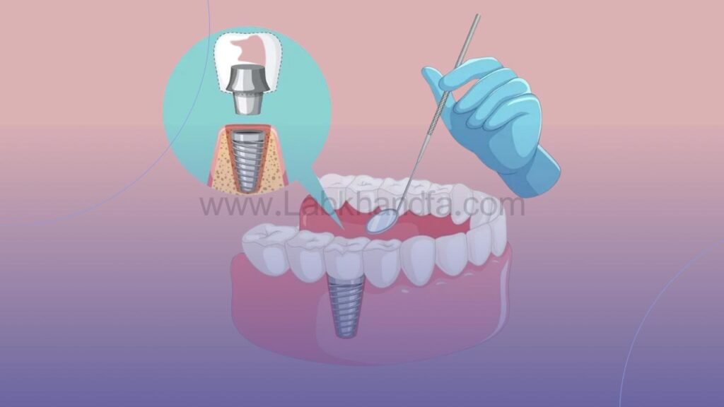 تصویری نمادین از معاینه  ایمپلنت دندان توسط دندانپزشک 