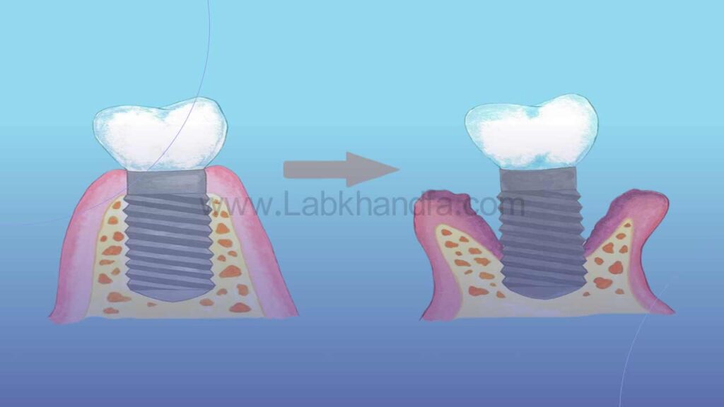 تصویری شماتیک از پس زدگی ایمپلنت دندان