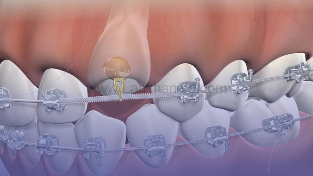 درمان دندان نهفته با ارتودنسی