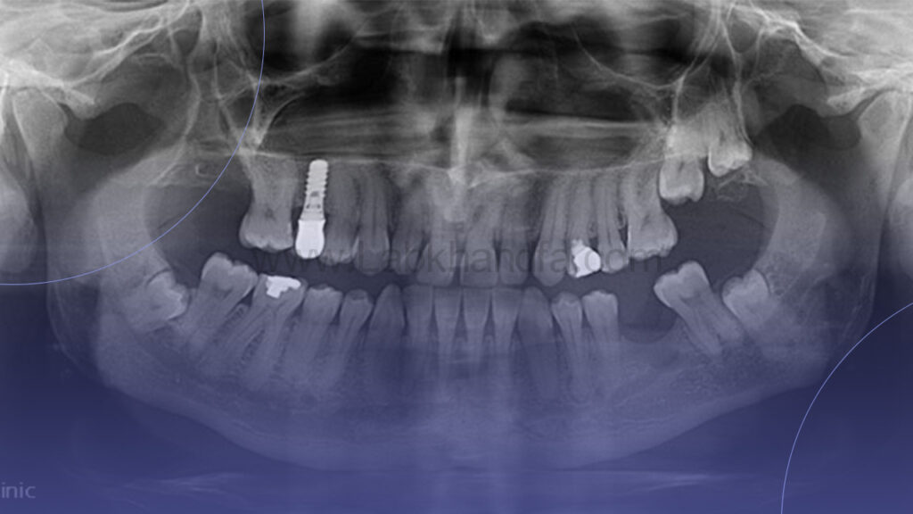 بررسی دهان و دندان قبل از ایمپلنت با رادیوگرافی