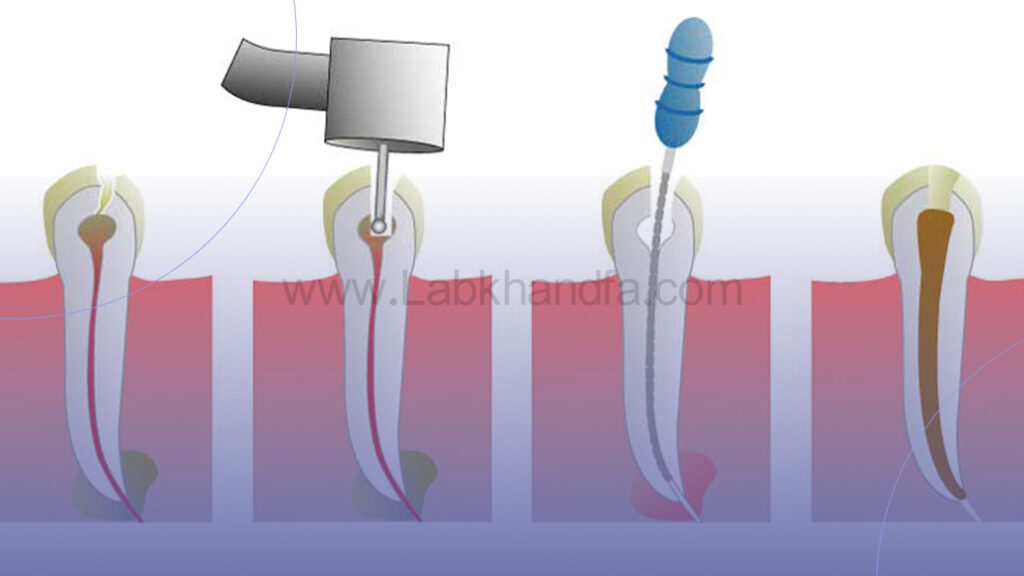 درمان ریشه دندان