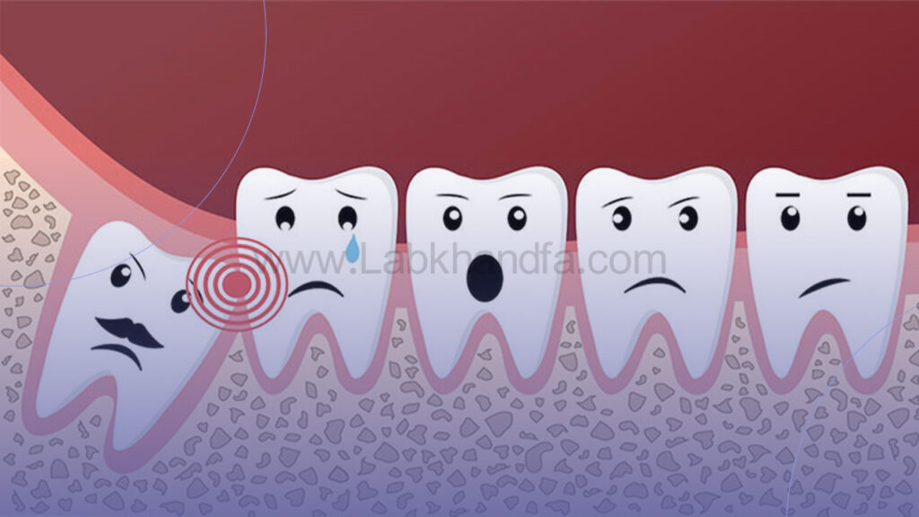روییدن نادرست دندان عقل