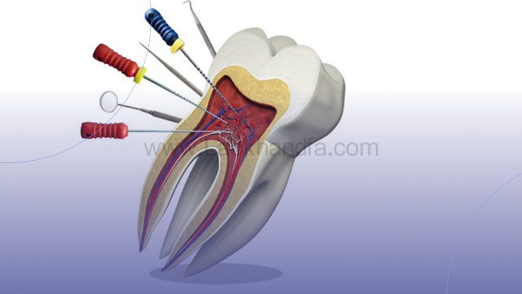 درمان ریشه و عصب دندان