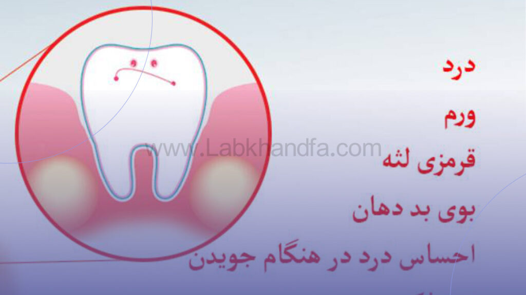 علائم آبسه دندان