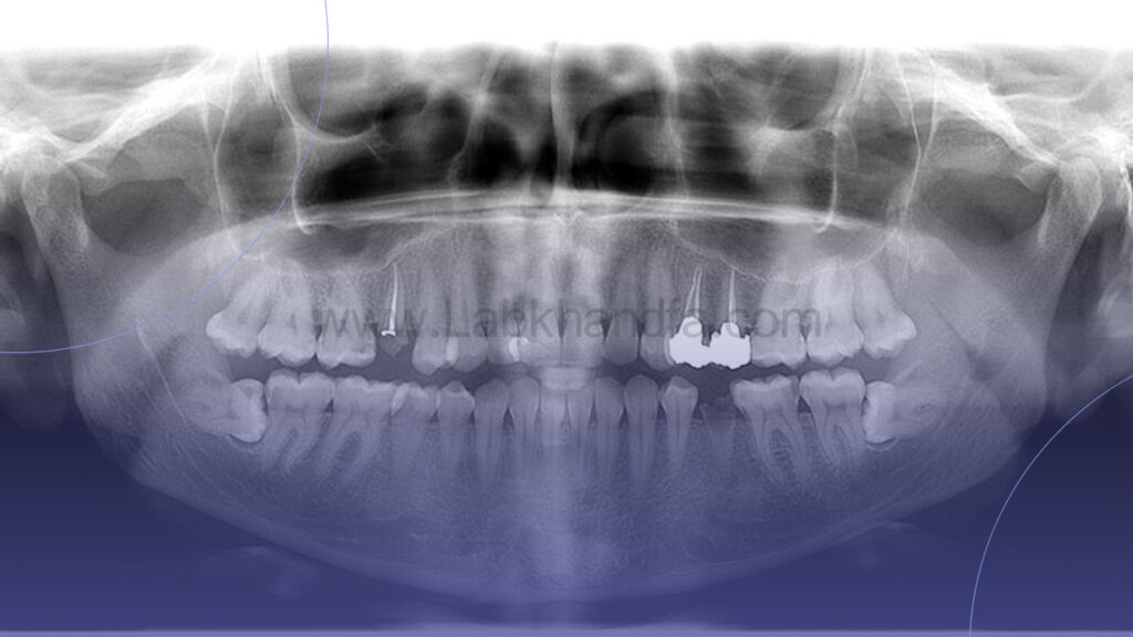 عکس خارج دهانی