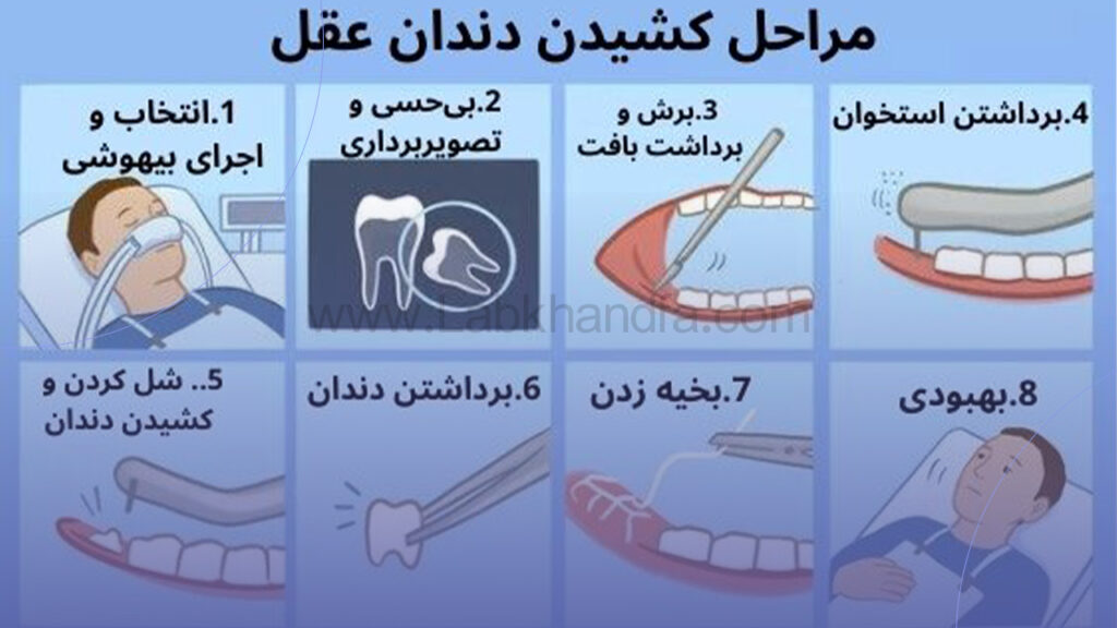 جراحی دندان عقل