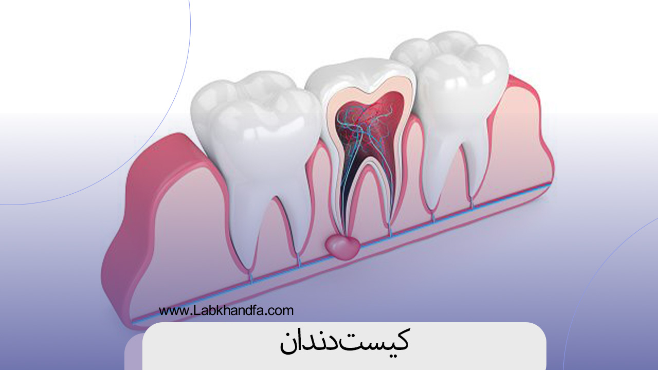 کیست دندان چیست؟