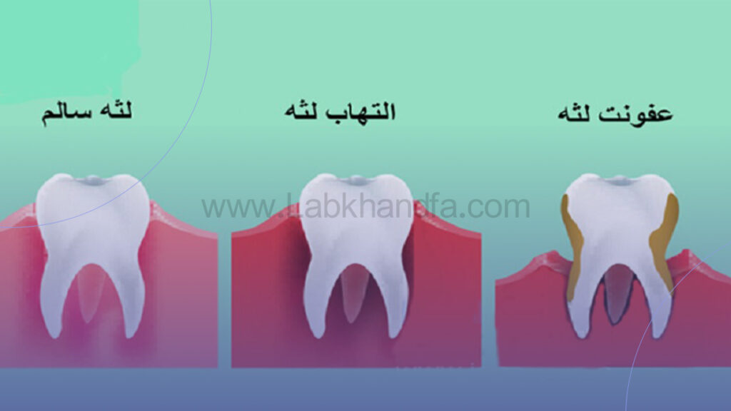 انواع بیماری لثه