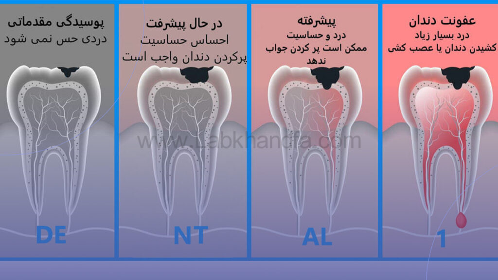 روند پوسیدگی دندان