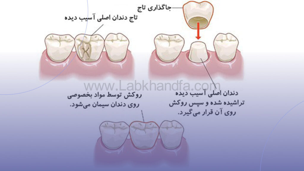 مراحل روکش دندان