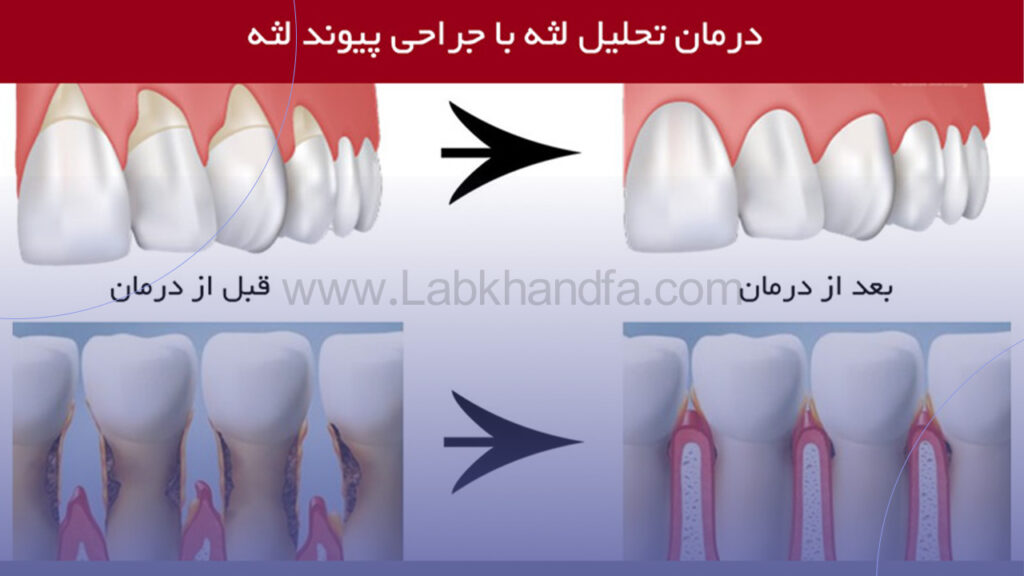 پیوند لثه برای درمان تحلیل لثه