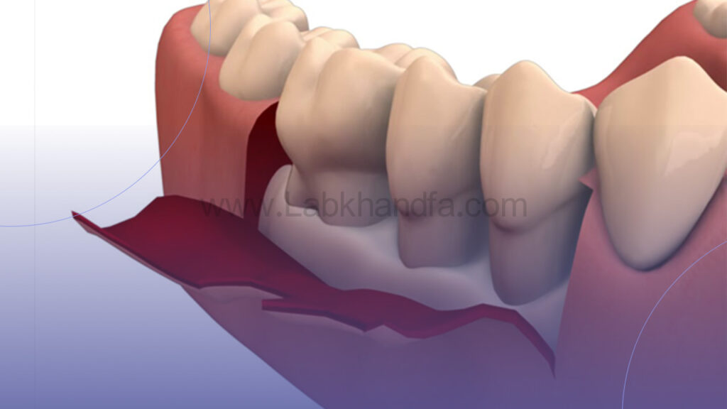 جراحی لثه چیست؟