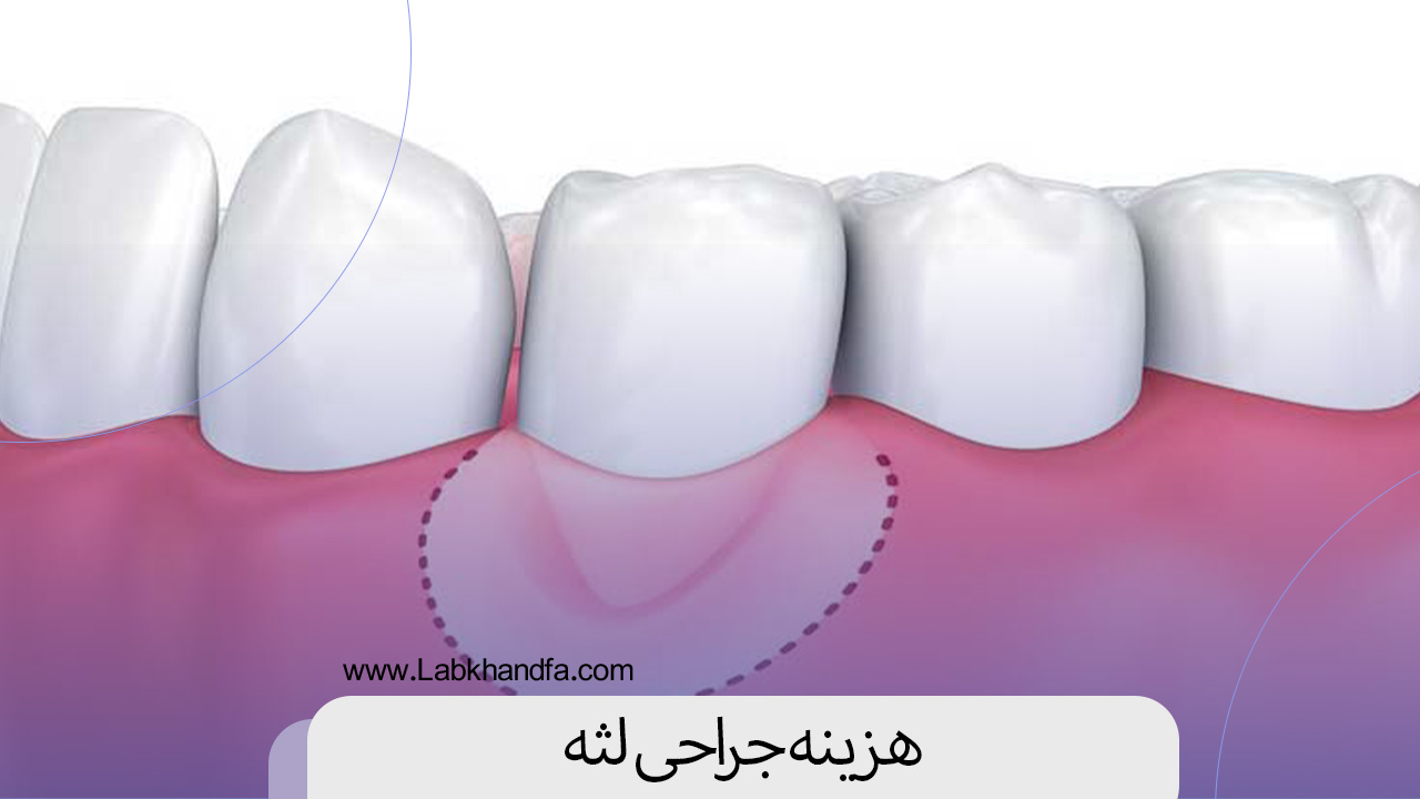 هزینه جراحی لثه