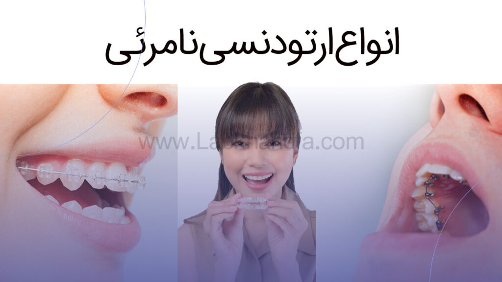 انواع ارتودنسی نامرئی