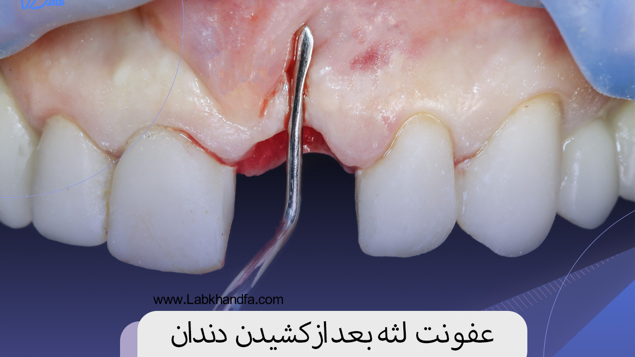 عفونت لثه بعد از کشیدن دندان