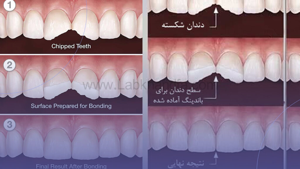 ترمیم دندان جلو با روش باندینگ